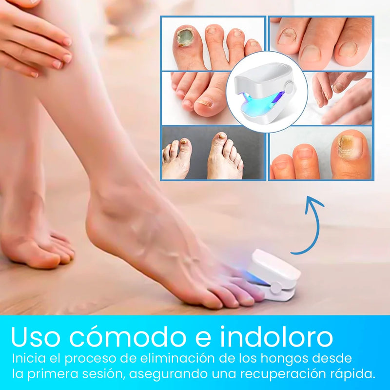 ¡Unas fuertes y libres de hongos en 7 minutos por ciclo! Conoce el tratamiento láser CuraLáser para unas perfectas.