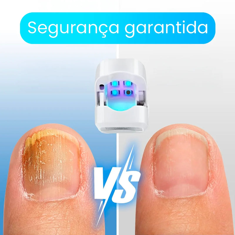 ¡Unas fuertes y libres de hongos en 7 minutos por ciclo! Conoce el tratamiento láser CuraLáser para unas perfectas.