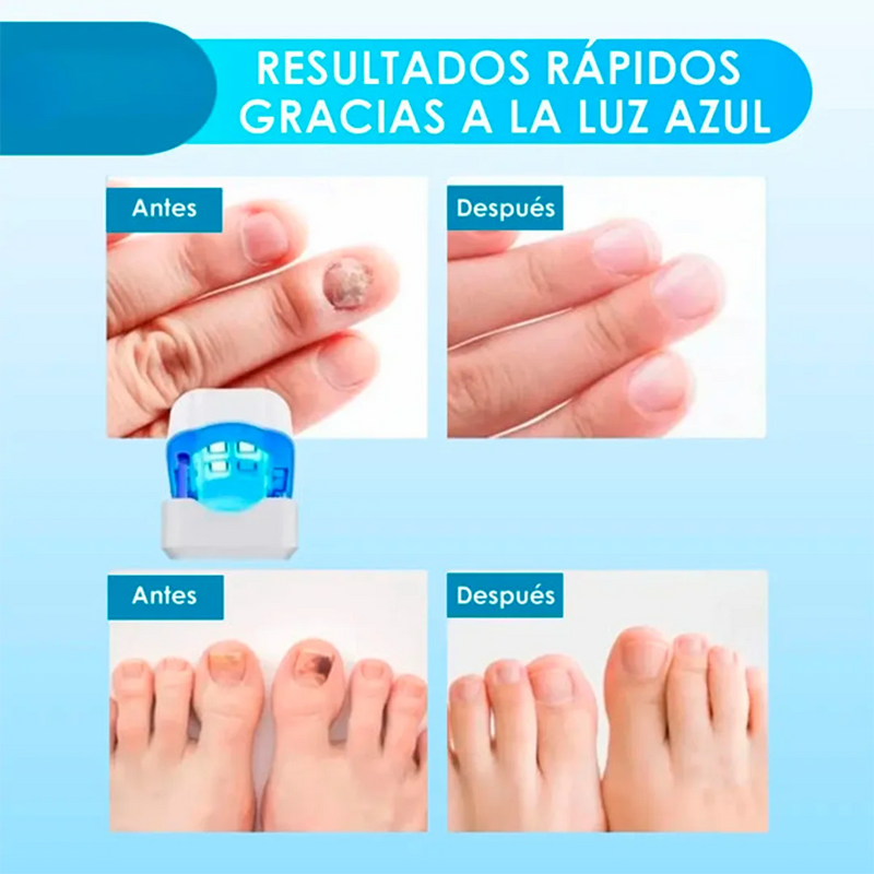¡Unas fuertes y libres de hongos en 7 minutos por ciclo! Conoce el tratamiento láser CuraLáser para unas perfectas.